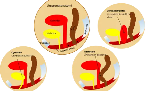 Illustrationer visar bäckenbottenproblem: livmoderframfall, cystocele och rektosele. Normal anatomi visas först.