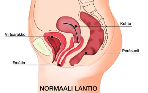 Illustration av normalt bäcken med livmoder, urinblåsa och ändtarm. Kan ge en förståelse för varför man kan ha ont i magen vid framfall.
