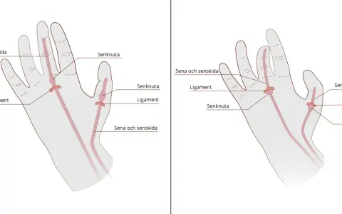 Illustrationer av handens senor, ligament och senknutor. En senknuta kan orsaka stela fingrar.