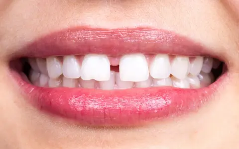 Närbild på en mun med ett tydligt diastema mediale mellan framtänderna. Läpparna är glansiga och rosa.