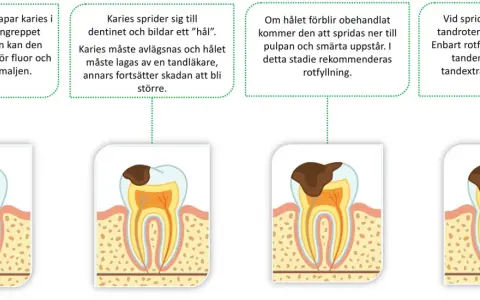 Bilden visar hur karies utvecklas i en tand, från emaljen till pulpan och roten. Om karies inte behandlas kan det leda till abscess och tandutdragning.