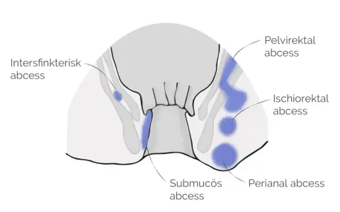 Illustration visar olika typer av abscesser i underlivet: perianal, ischiorektal, submukös, intersfinkterisk och pelvirektal.