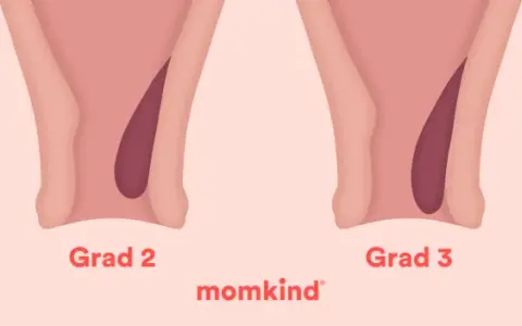 Illustrationer visar grader av anteflekterad uterus, från grad 1 till 4, med en mörkare nyans som representerar livmodern.