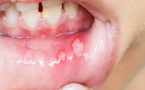Munnen visar sår som kan vara afte eller herpes. De är röda och inflammerade.
