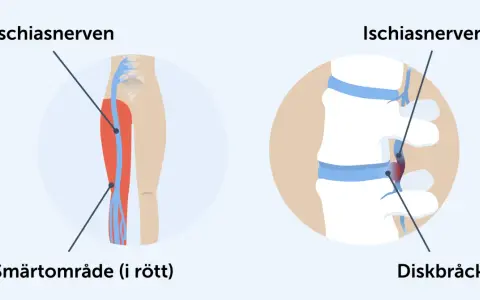 Illustration visar iskiasnerven och smärtområde i benet, samt diskbråck som orsakar akut ischias.