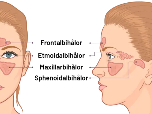 Illustration av bihålorna i ansiktet. Kan visa hur tandproblem kan leda till dental sinuit.