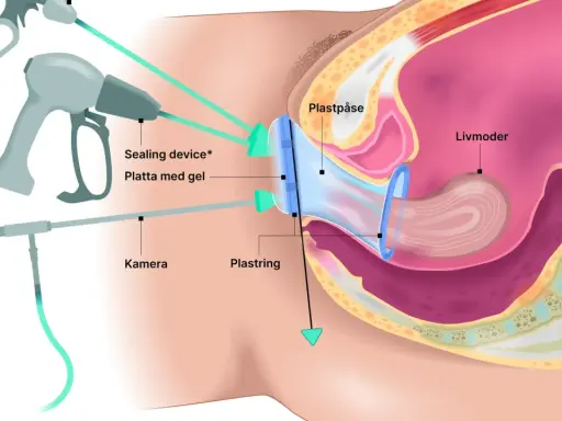 Illustration av en framfall operation med en plastpåse och ring som stödjer livmodern. Verktyg för kirurgi syns.