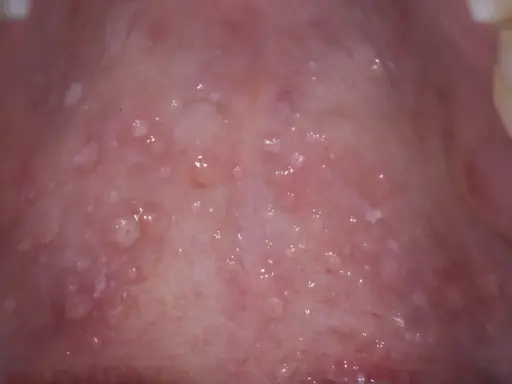 Närbild av gommen med många små blåsor, vilket kan vara tecken på herpes i gommen.