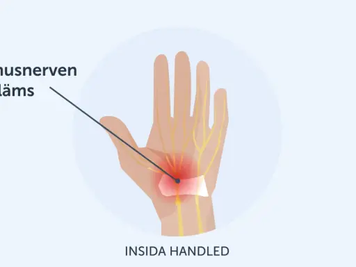 Illustration av handleden där medianusnerven kläms, vilket orsakar karpaltunnelsyndrom och ont i tummen.