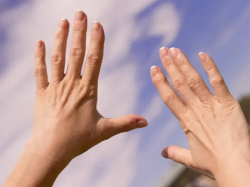 Två händer med sneda fingrar, kanske ett tecken på reumatism, sträcks mot en blå himmel med moln.