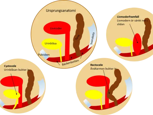 Illustrationer visar bäckenbottenproblem: livmoderframfall, cystocele och rektosele. Normal anatomi visas först.