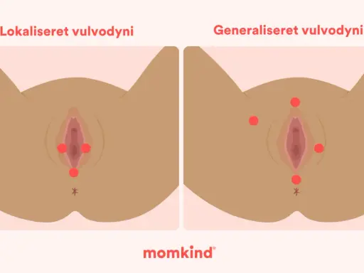 Illustrationer visar lokaliserad och generaliserad vulvodyni, med röda prickar som markerar smärtpunkter. Det kan kännas som ett tryck i underlivet.