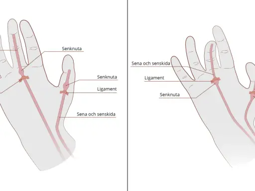 Illustrationer av handens senor, ligament och senknutor. En senknuta kan orsaka stela fingrar.