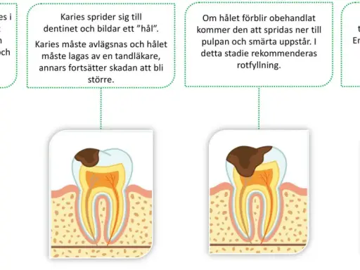 Bilden visar hur karies utvecklas i en tand, från emaljen till pulpan och roten. Om karies inte behandlas kan det leda till abscess och tandutdragning.