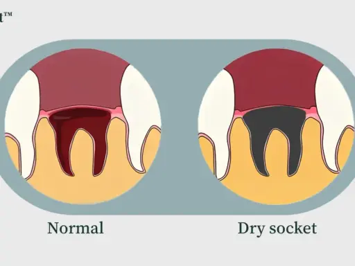 Illustration visar normal tandutdragning med blodkoagel och en alveol med en torr håla, där tandbenet är synligt och mörkt.