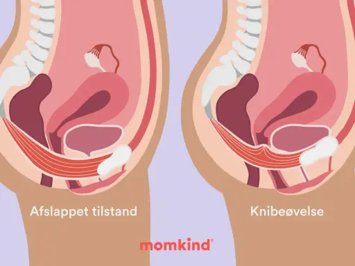 Illustration visar bäckenbottenmuskulaturen i avslappnat och kontraherat läge. Knipövningar är en del av symfysit behandling.