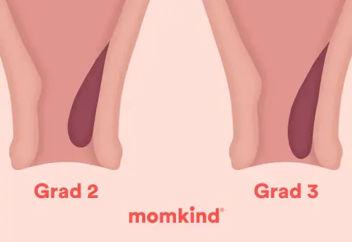 Illustrationer visar grader av anteflekterad uterus, från grad 1 till 4, med en mörkare nyans som representerar livmodern.