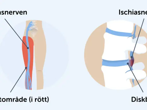Illustration visar iskiasnerven och smärtområde i benet, samt diskbråck som orsakar akut ischias.