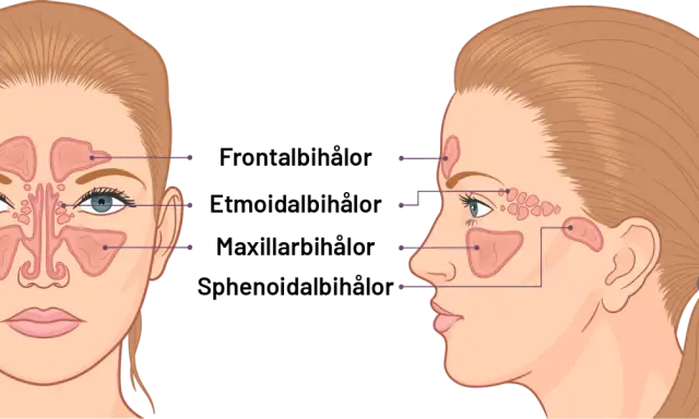 Illustration av bihålorna i ansiktet. Kan visa hur tandproblem kan leda till dental sinuit.