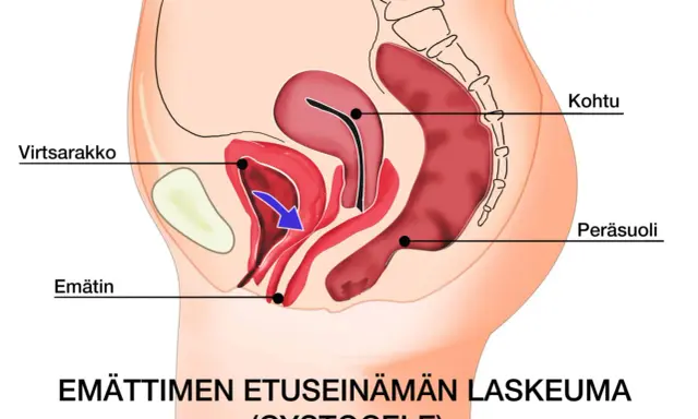 Illustration av bäckenorgan som visar en utbuktning i slidan, en cystocele, där urinblåsan buktar ner.