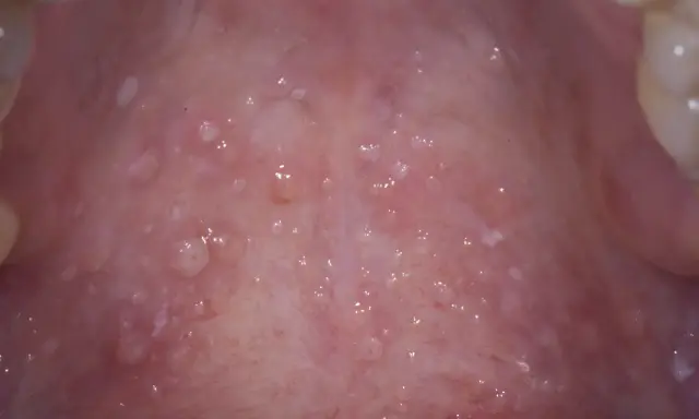 Närbild av gommen med många små blåsor, vilket kan vara tecken på herpes i gommen.