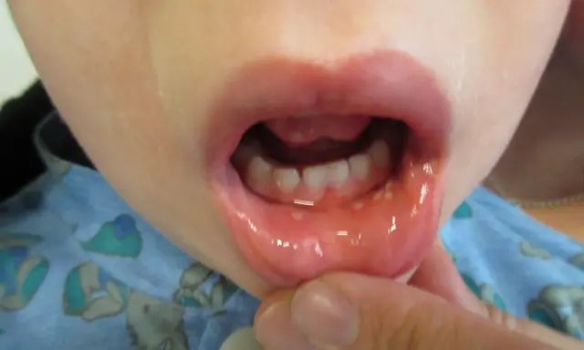 Barnets mun visar små blåsor och rodnad, tecken på herpetisk gingivostomatit.