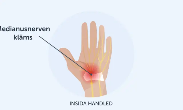 Illustration av handleden där medianusnerven kläms, vilket orsakar karpaltunnelsyndrom och ont i tummen.
