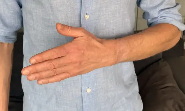 Man visar sin hand, tummen är böjd. Kan vara relaterat till senskideinflammation tumme.