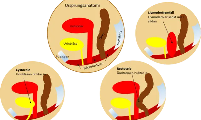 Illustrationer visar bäckenbottenproblem: livmoderframfall, cystocele och rektosele. Normal anatomi visas först.
