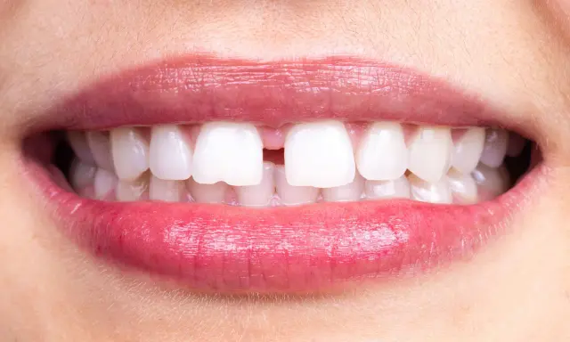 Närbild på en mun med ett tydligt diastema mediale mellan framtänderna. Läpparna är glansiga och rosa.