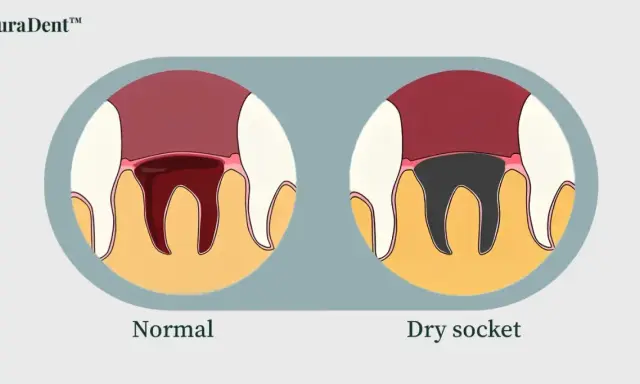 Illustration visar normal tandutdragning med blodkoagel och en alveol med en torr håla, där tandbenet är synligt och mörkt.