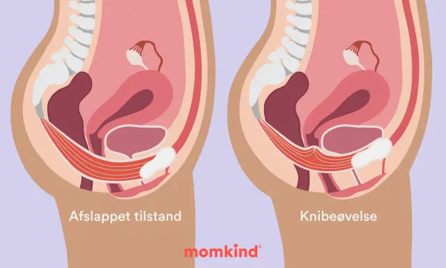 Illustration visar bäckenbottenmuskulaturen i avslappnat och kontraherat läge. Knipövningar är en del av symfysit behandling.