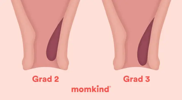 Illustrationer visar grader av anteflekterad uterus, från grad 1 till 4, med en mörkare nyans som representerar livmodern.