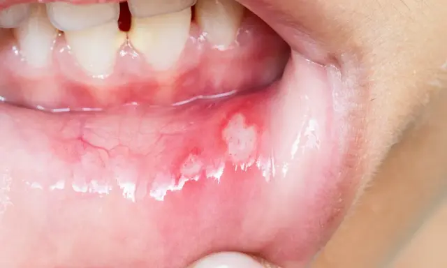 Munnen visar sår som kan vara afte eller herpes. De är röda och inflammerade.