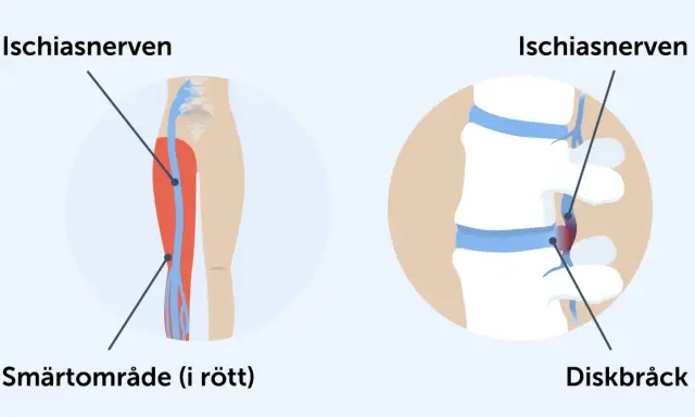 Illustration visar iskiasnerven och smärtområde i benet, samt diskbråck som orsakar akut ischias.
