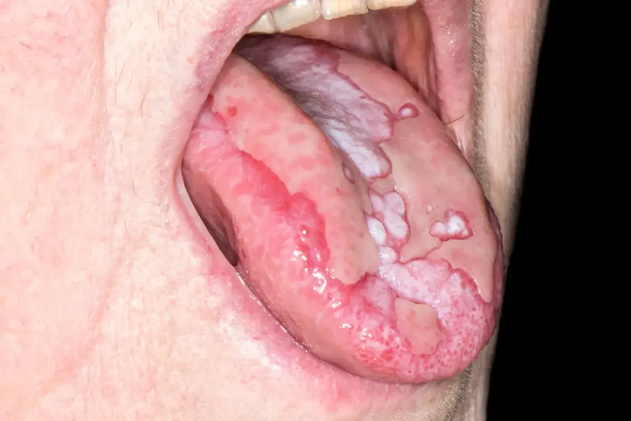 Tungan visar vita fl&auml;ckar och s&aring;r, tecken p&aring; lichen i munnen, som kan vara en riskfaktor f&ouml;r cancer.