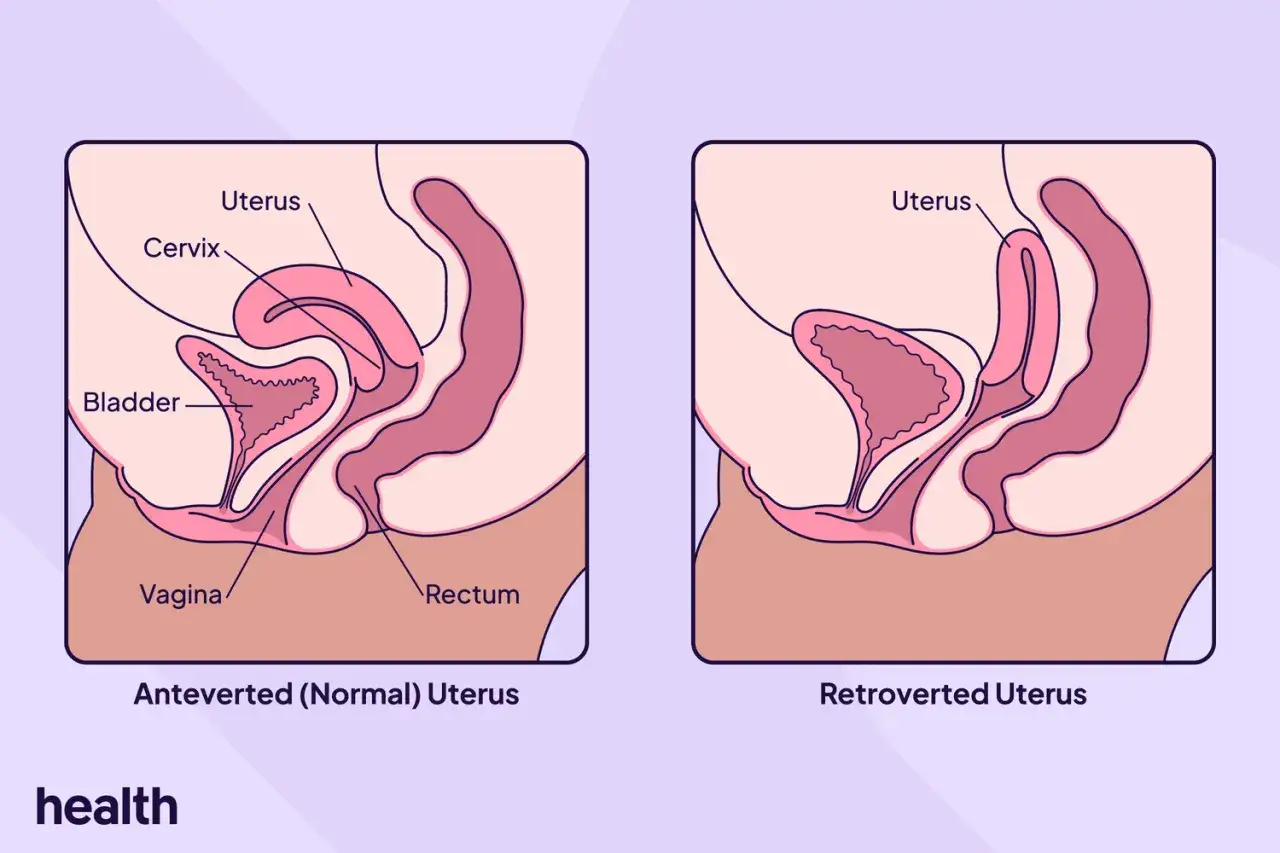 Illustration visar en anteflekterad uterus (normal) och en retroverterad uterus.