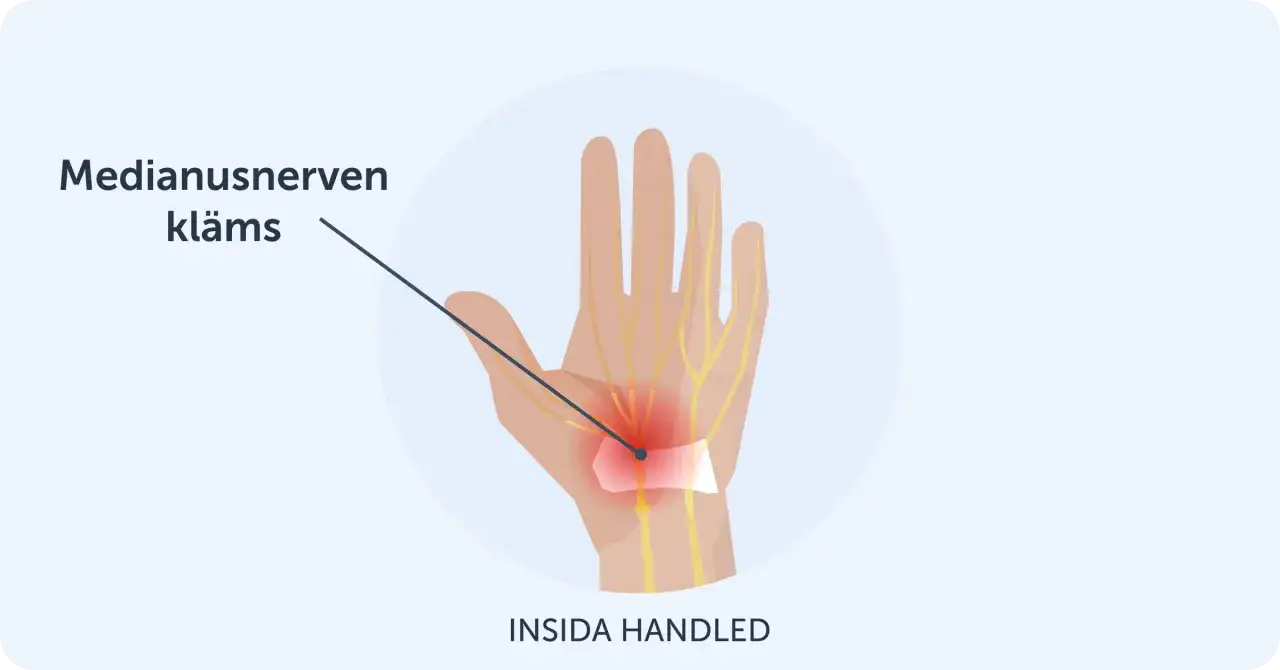 Illustration visar hur medianusnerven kl&auml;ms i handleden, vilket kan orsaka karpaltunnelsyndrom och ont i tummen.
