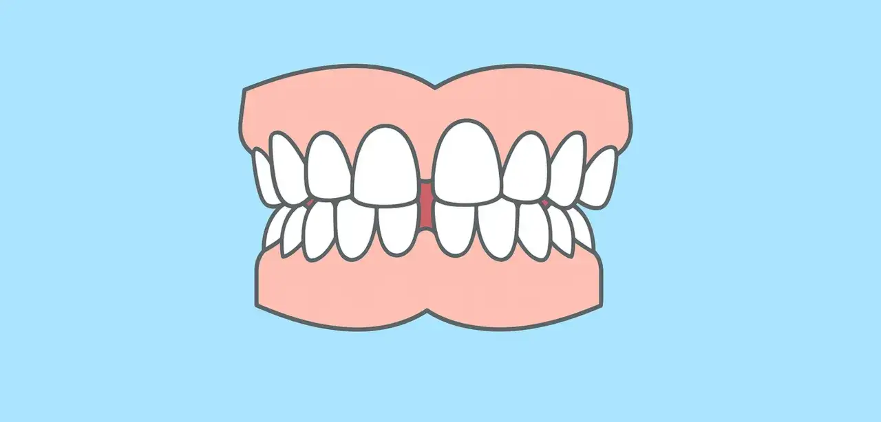 En illustration av t&auml;nder med ett tydligt diastema mediale, ett mellanrum mellan framt&auml;nderna.