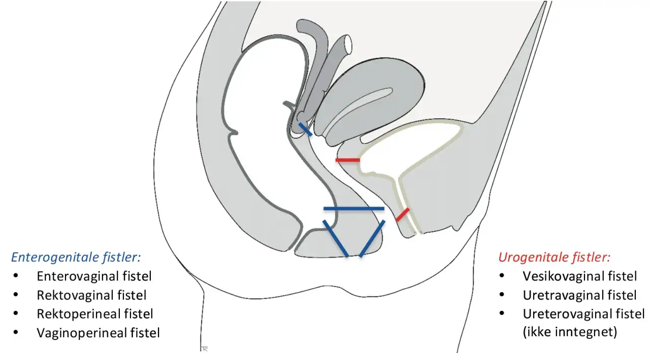 Illustration visar olika typer av fistel i underlivet, inklusive enterogenitala och urogenitala fistlar.