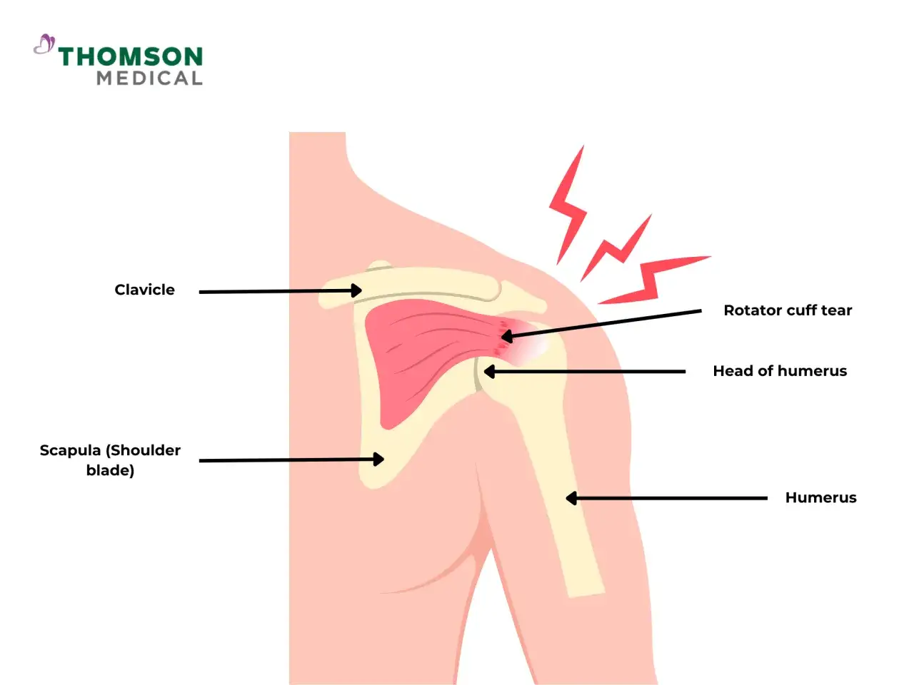 Illustration av en axel med en rotatorcuff-skada, vilket g&ouml;r att personen inte kan lyfta armen efter fall.