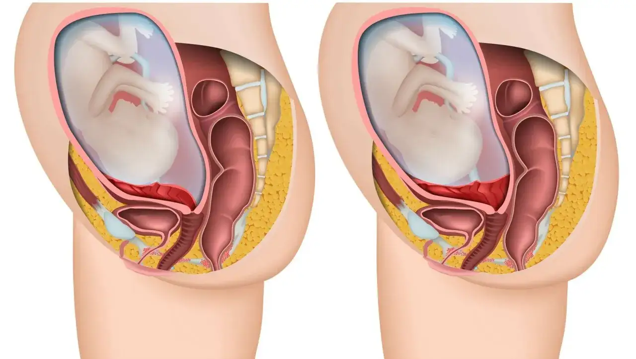 Illustration av en gravid livmoder med foster. Till h&ouml;ger syns hur moderkakan lossnar.
