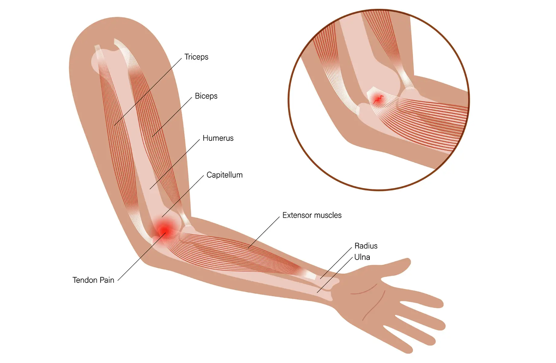 Illustration visar armens anatomi med fokus på smärta vid armbågen, en möjlig skillnad musarm tennisarmbåge.