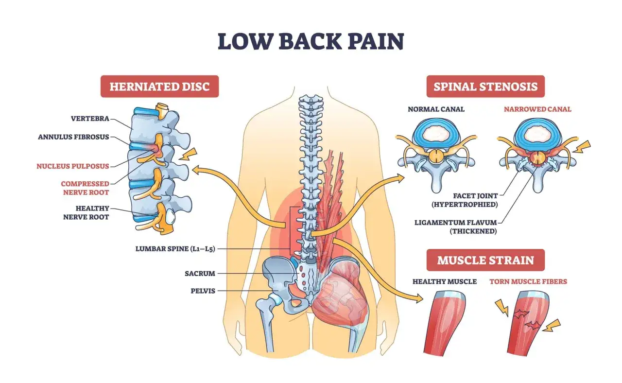 Illustration visar l&auml;ndryggen med diskbr&aring;ck, spinal stenos och muskelstr&auml;ckning. L5 kota kan p&aring;verkas.